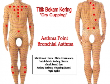 dry-cupping